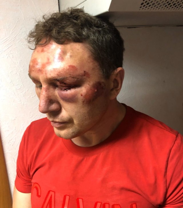 Петр Зверев с ушибами от избиений после обыска в его квартире. Фото из архива Зверевых