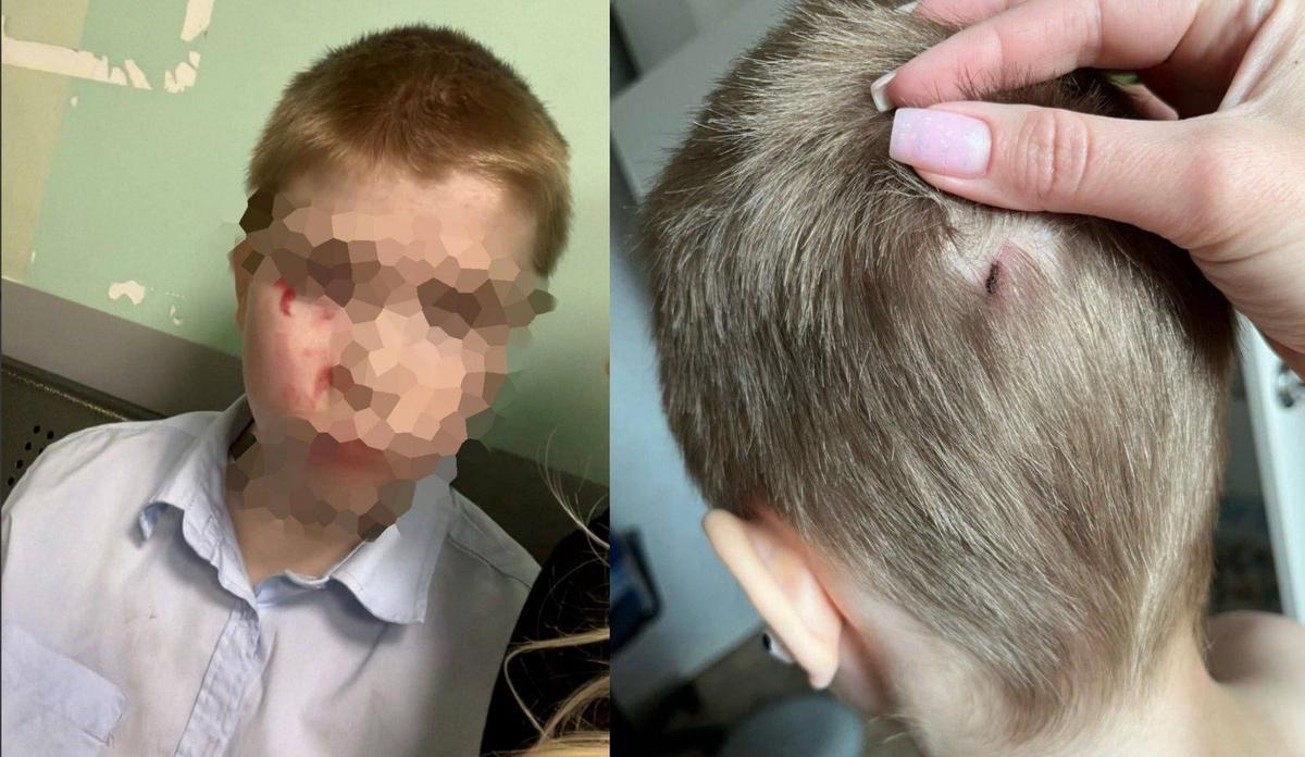 Один из пострадавших от Владимира пятиклассников. Фото: соцсети