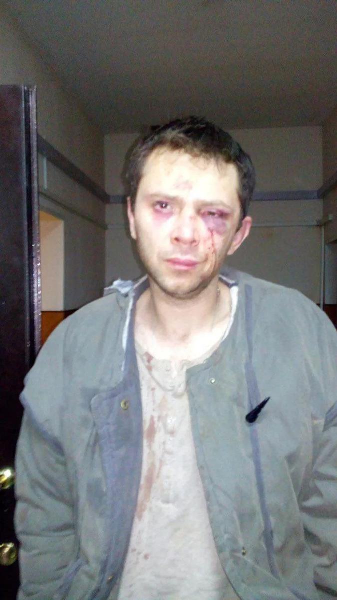 Мартынов после избиения. Фото из личного архива