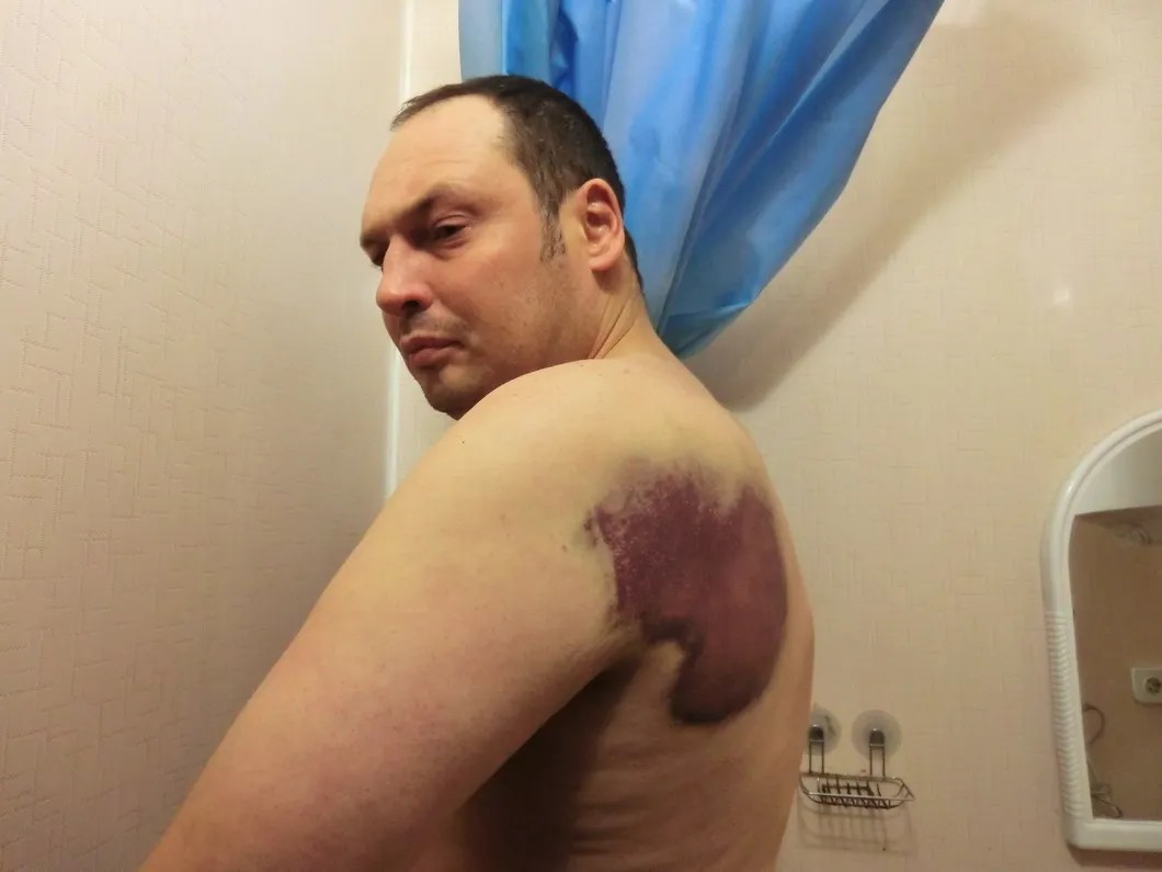 Иван Любшин демонстрирует синяк от ушиба на спине