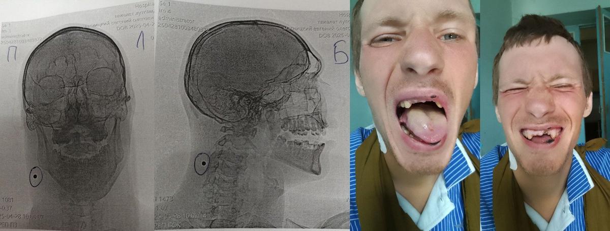 Осколок залетел в рот и застрял в шее. Фото: архив Николая Щербакова