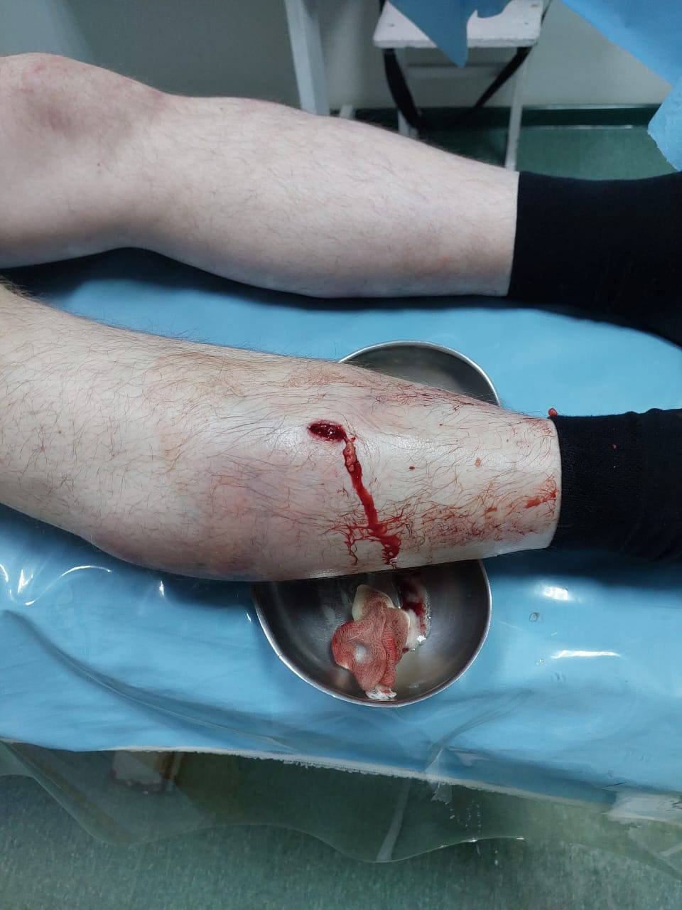 Ножевое ранение в ногу у адвоката Александра Немова. Фото: «Команда против пыток»