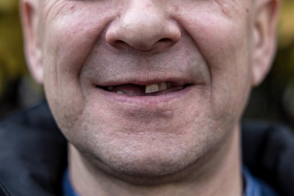 После удара у Романа Гусева случился перелом челюсти — пришлось удалить зубы. Фото: Арден Аркман / «Новая газета»