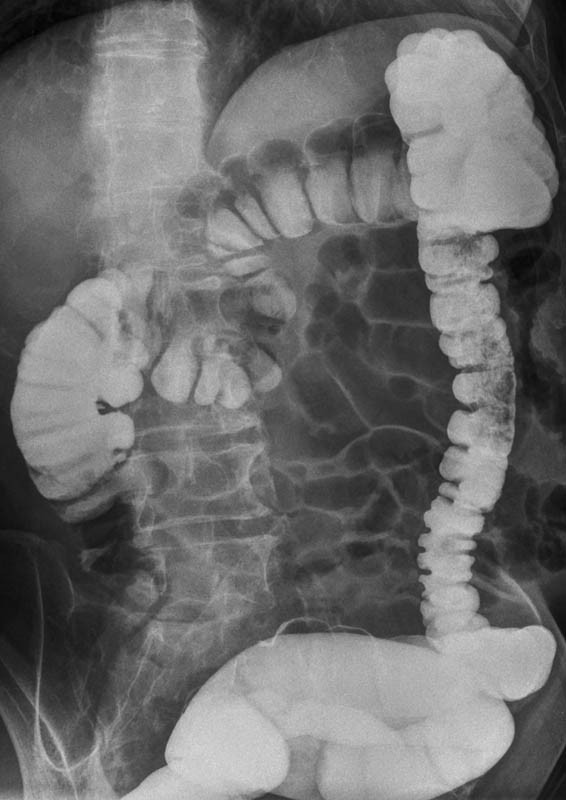 На фото: рентгеновский снимок, для съемки которого пациенту вводили контраст медицинского бария