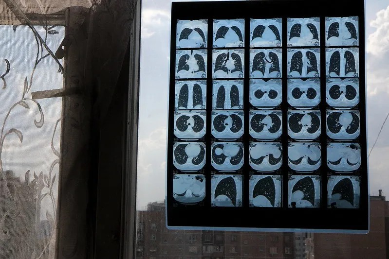 Компьютерная томография органов грудной клетки. Фото: Светлана Виданова / «Новая газета»