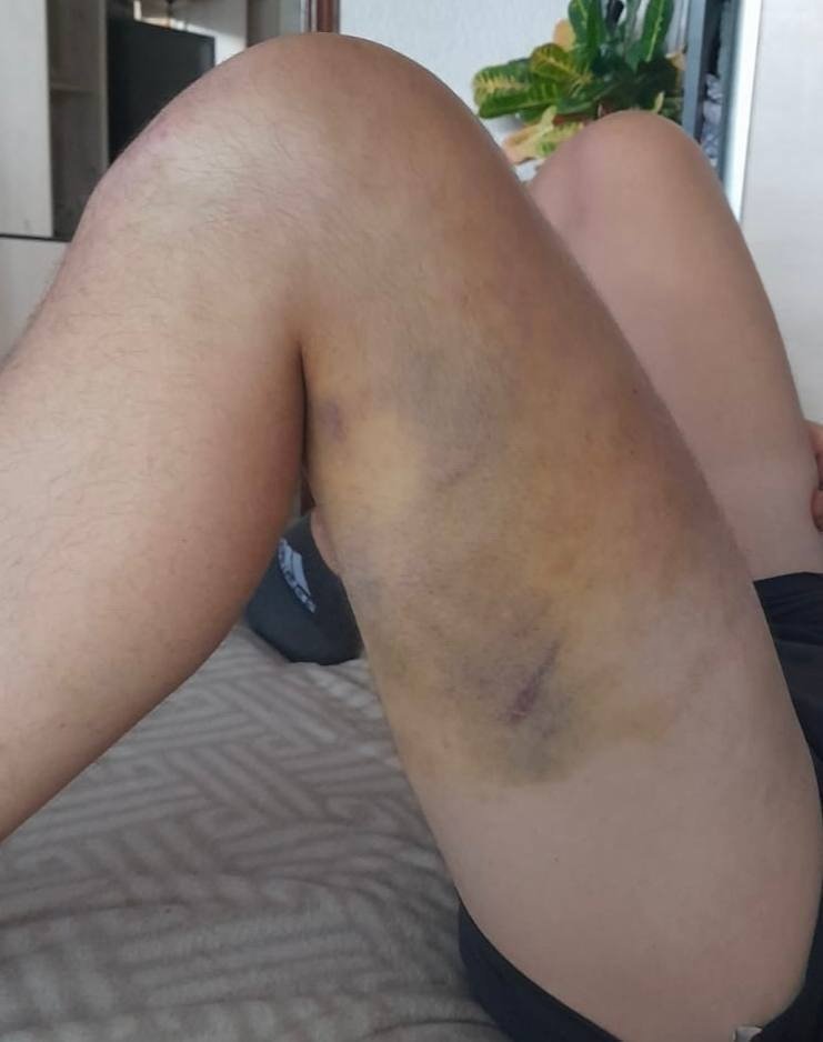 Повреждения Натальи. Фото: соцсети