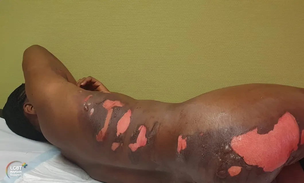 Фото женщины из Нигерии, пострадавшей в результате вылитого на нее кипятка. Фото предоставлено нидерландской организацией LGBT+ Asylum Support