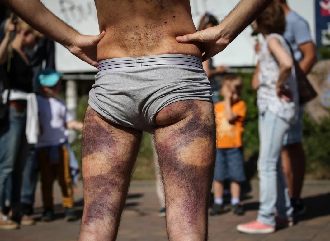 Вышедший из изолятора на свободу беларус участвует в акции против насилия — показывает следы пережитых пыток. Фото: EPA